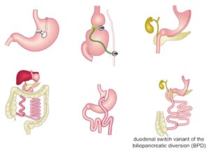 Gastric Bypass Alcohol Liver Damage