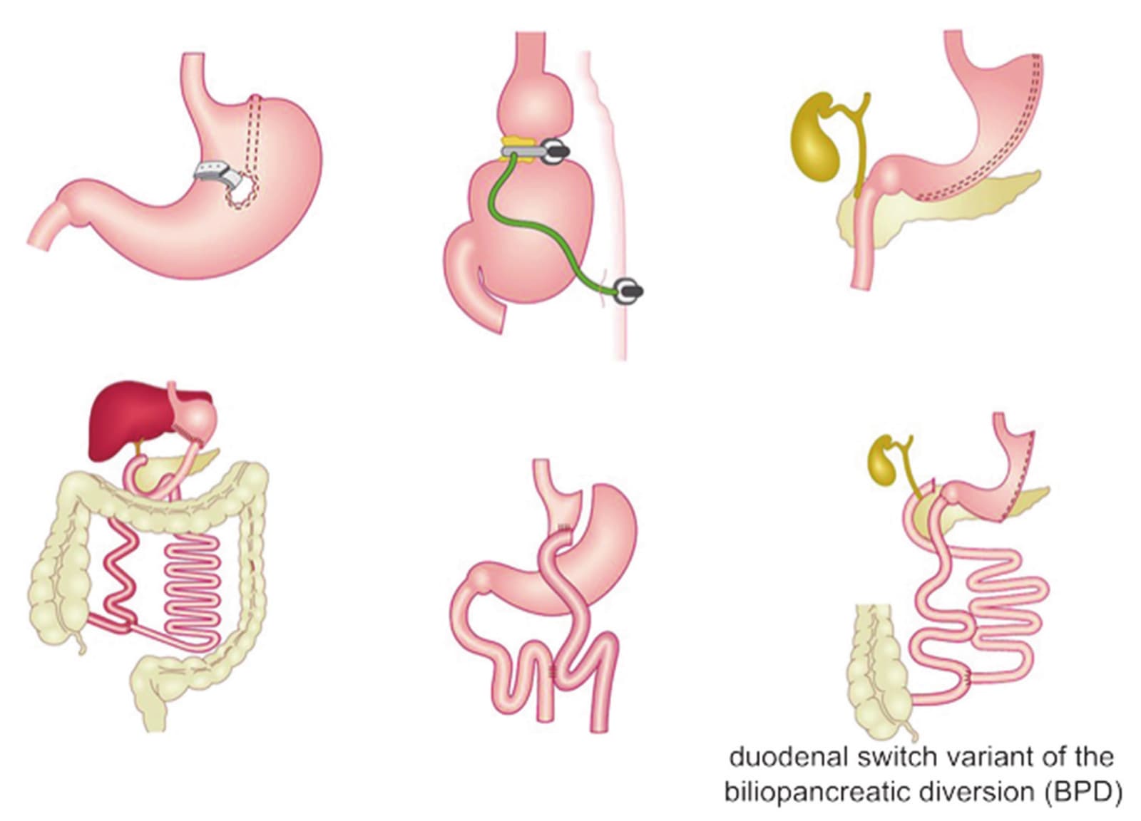 Gastric Bypass Alcohol Liver Damage