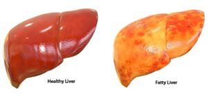 Fatty Liver