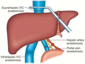 Liver Transplantation