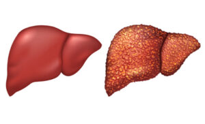 Healthy and diseased liver comparison