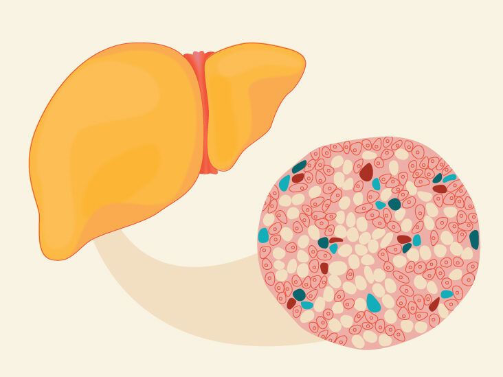 Fatty Liver