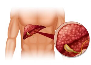 Diagram of sclerosis in human