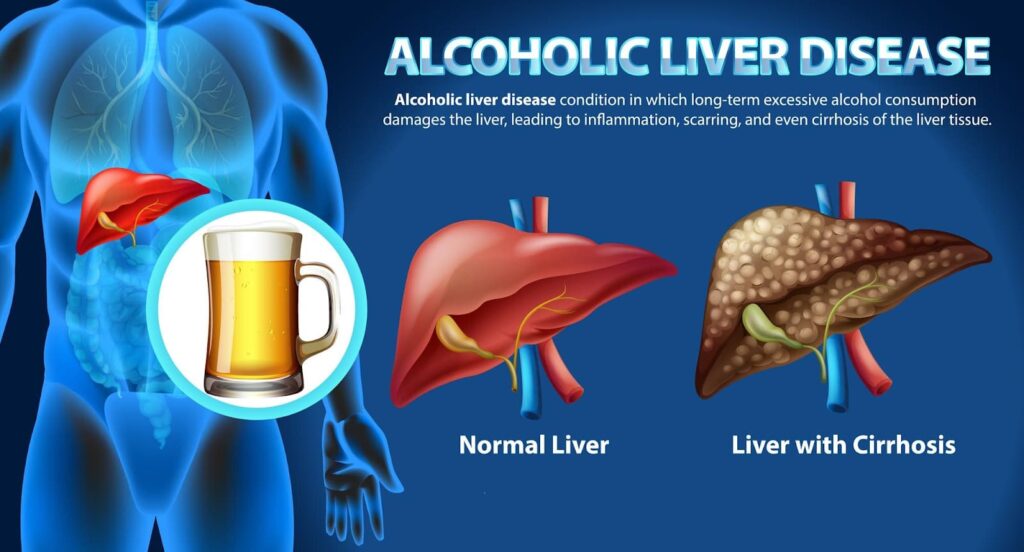 Healthy and diseased liver from alcohol