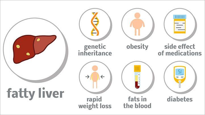 Non Alcoholic Fatty Liver